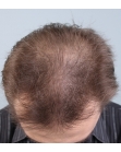 Before Hair Transplant&nbsp;2 Sessions (Areas)